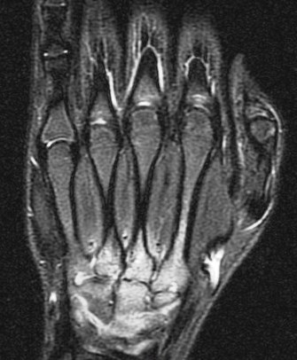 Figure 4 for case Juvenile idiopathic arthritis